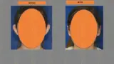 Before and after ear reconstruction cost — case 10