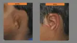 Before and after ear reconstruction cost — case 12