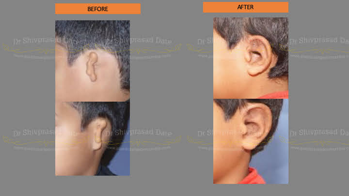 Before and after ear reconstruction — case 2