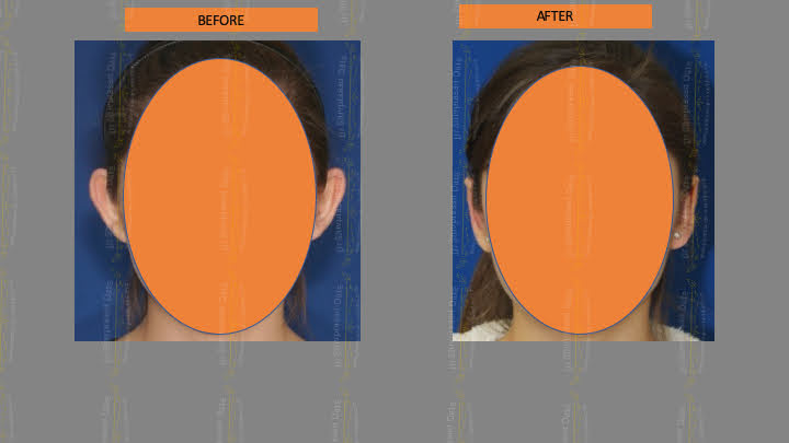 Before and after ear reconstruction — case 4