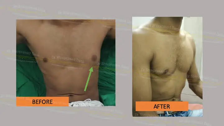 Before and after gynecomastia — case 1