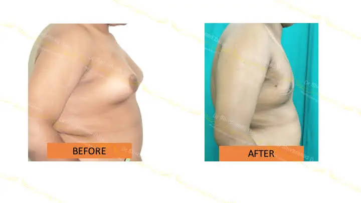Before and after gynecomastia — case 2