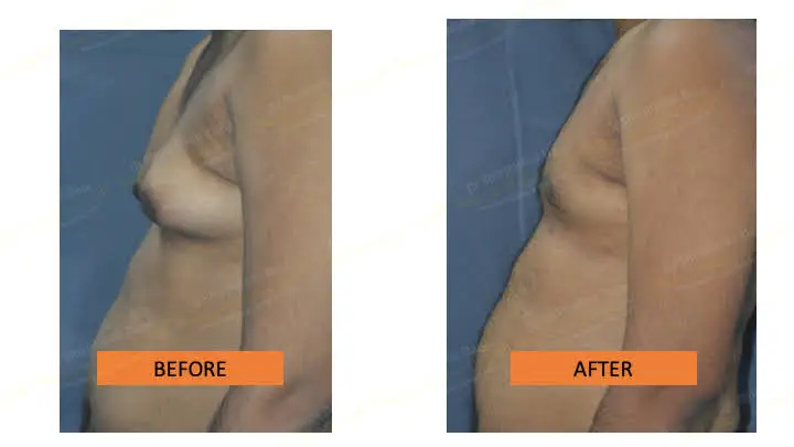 Before and after gynecomastia — case 3