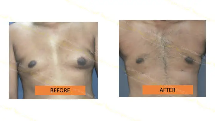 Before and after gynecomastia — case 4
