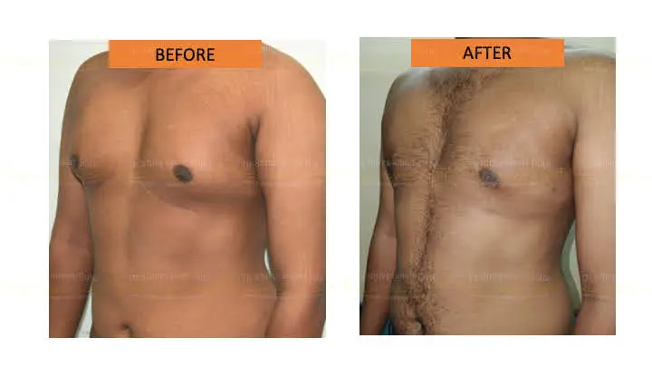 Before and after gynecomastia — case 5
