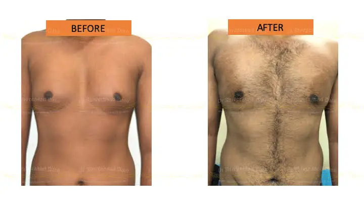 Before and after gynecomastia — case 6