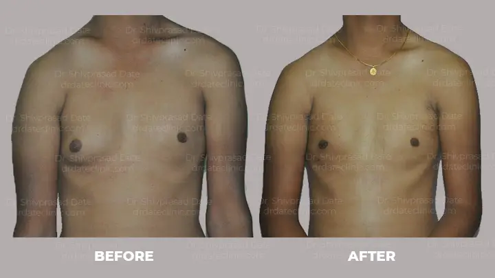 Before and after gynecomastia — case 7