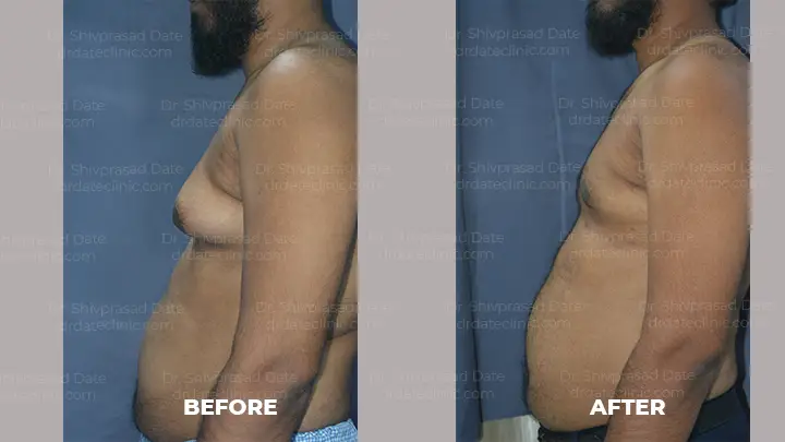Before and after gynecomastia — case 8