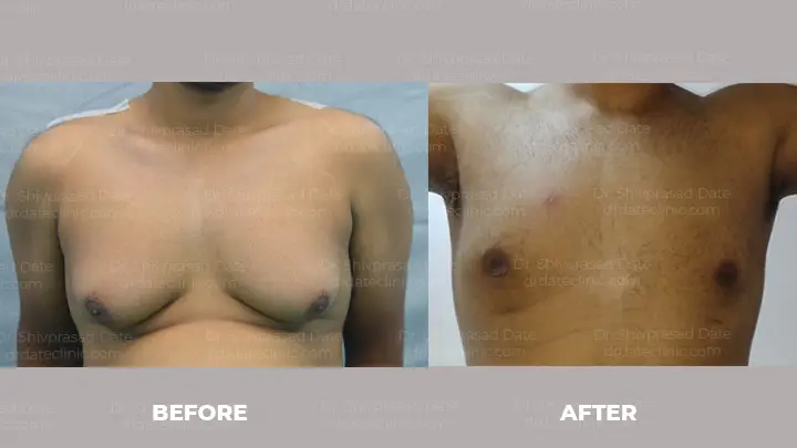 Before and after gynecomastia — case 9