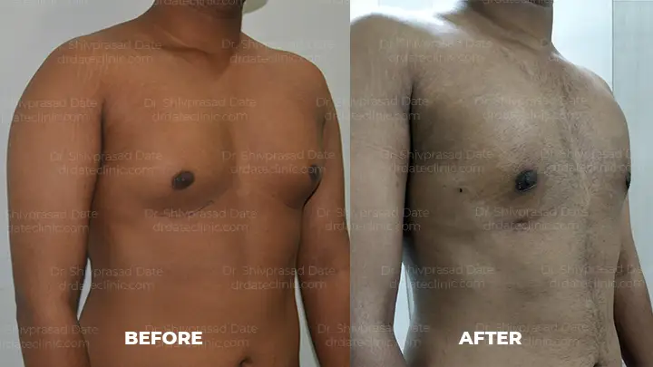 Before and after gynecomastia — case 10