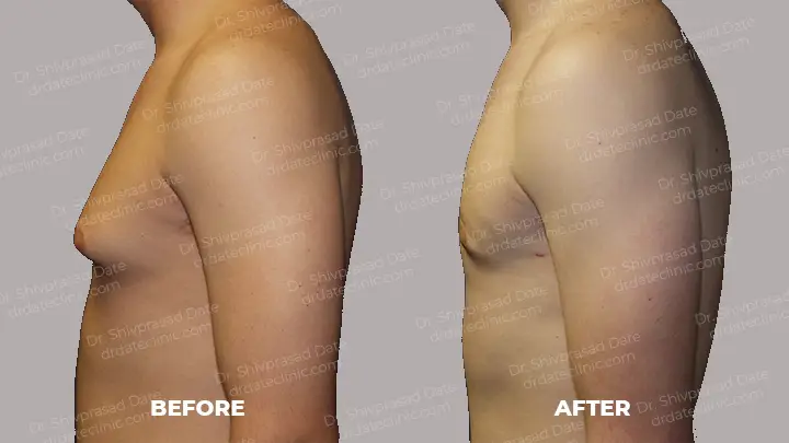 Before and after gynecomastia — case 11