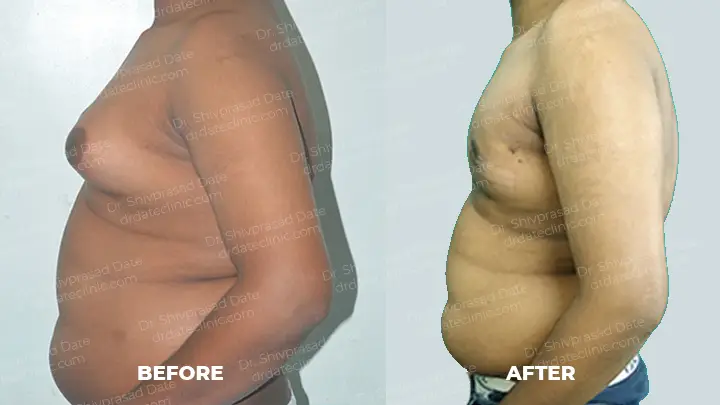 Before and after gynecomastia — case 12