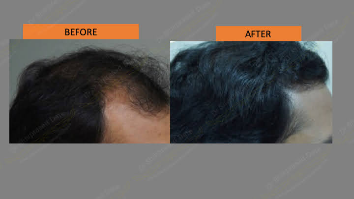 Before and after hair transplant — case 1