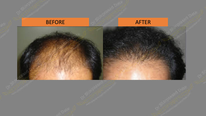 Before and after hair transplant — case 2