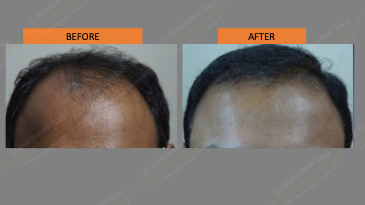 Before and after hair transplant — case 3