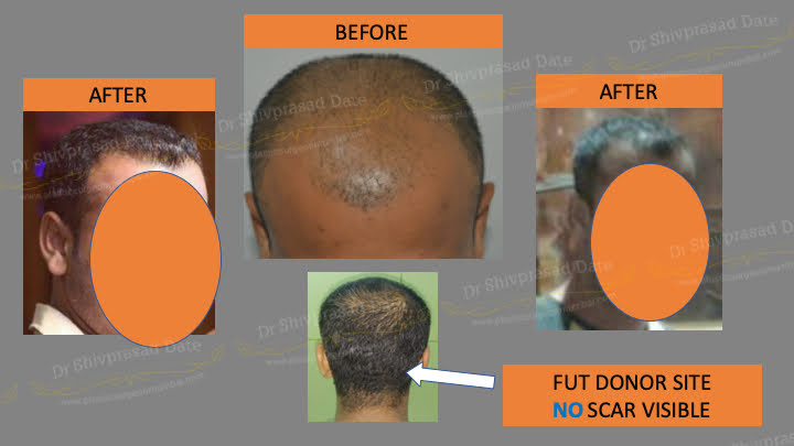 Before and after hair transplant — case 4