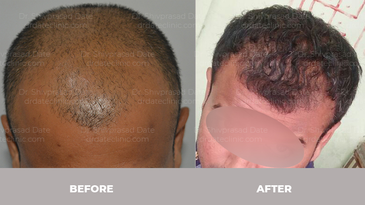 Before and after hair transplant — case 5