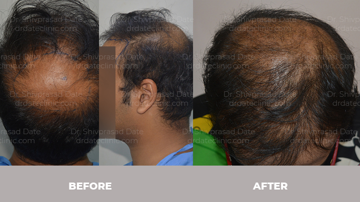 Before and after hair transplant — case 6