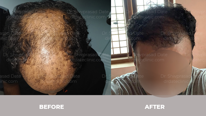 Before and after hair transplant — case 7