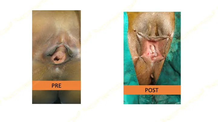 Before and after hymenoplasty — case 1
