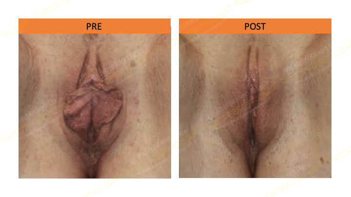 Before and after labiaplasty — case 1