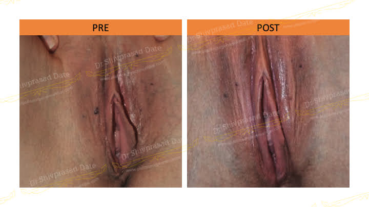 Before and after labiaplasty — case 2
