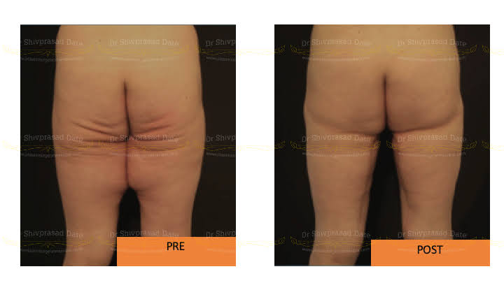 Before and after thigh lift — case 1