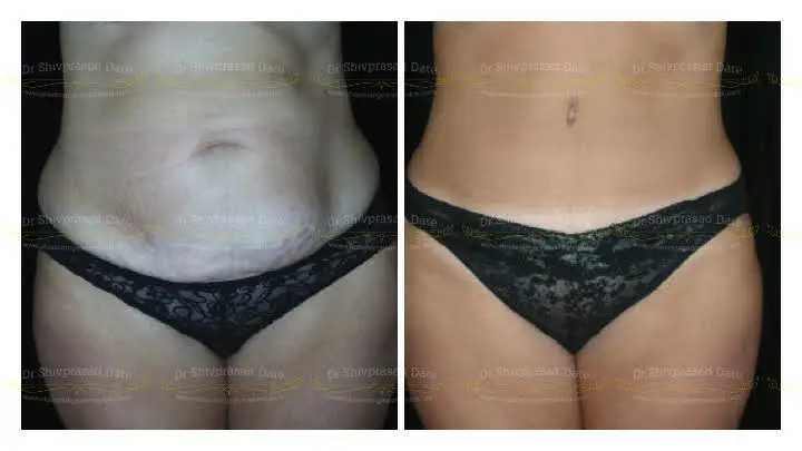 Before and after tummy tuck — case 1