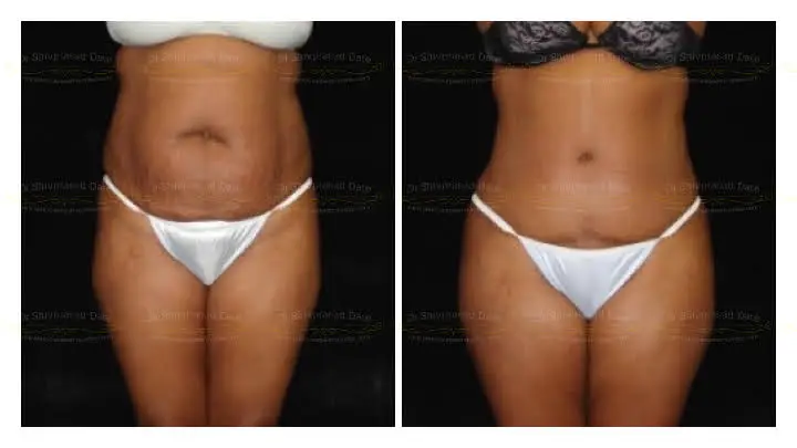 Before and after tummy tuck — case 2