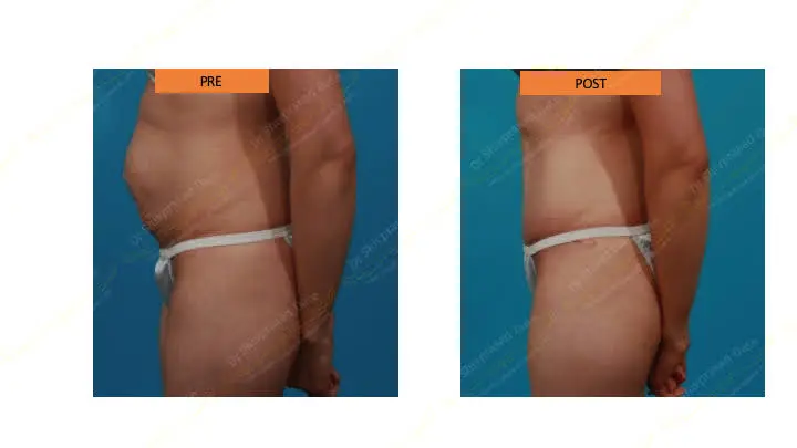 Before and after tummy tuck — case 3