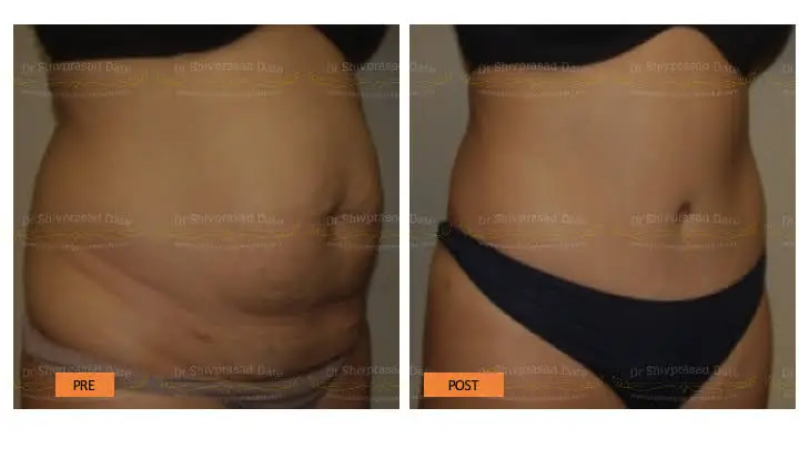 Before and after tummy tuck — case 4
