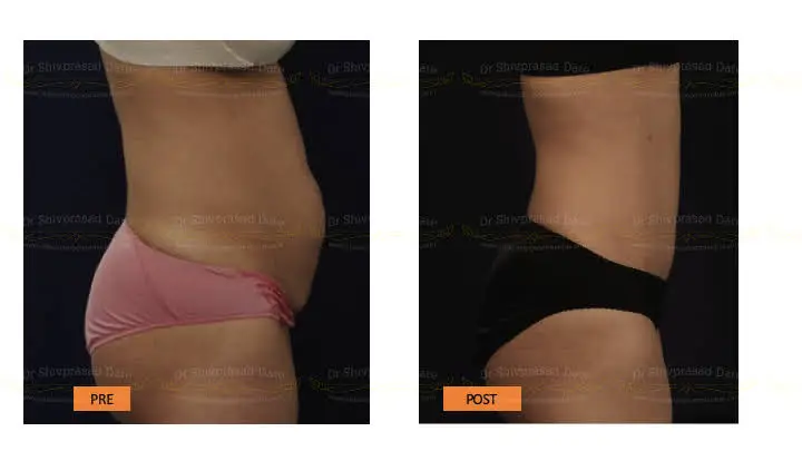 Before and after tummy tuck — case 5
