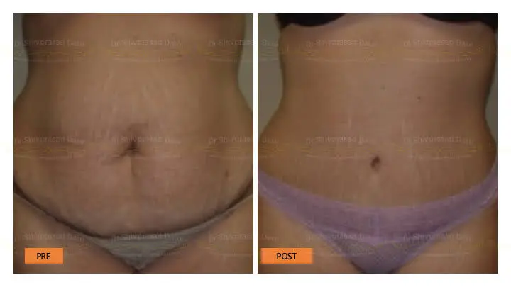 Before and after tummy tuck — case 6