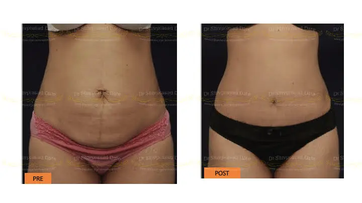 Before and after tummy tuck — case 7