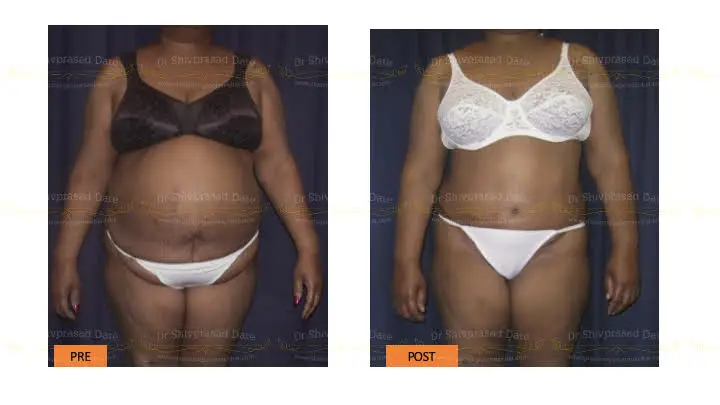 Before and after tummy tuck — case 8