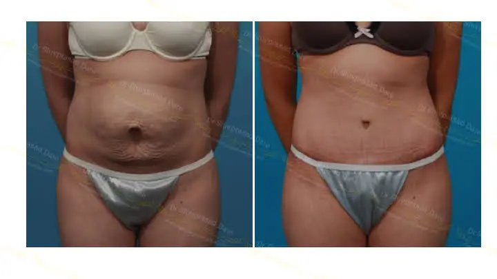 Before and after tummy tuck — case 9